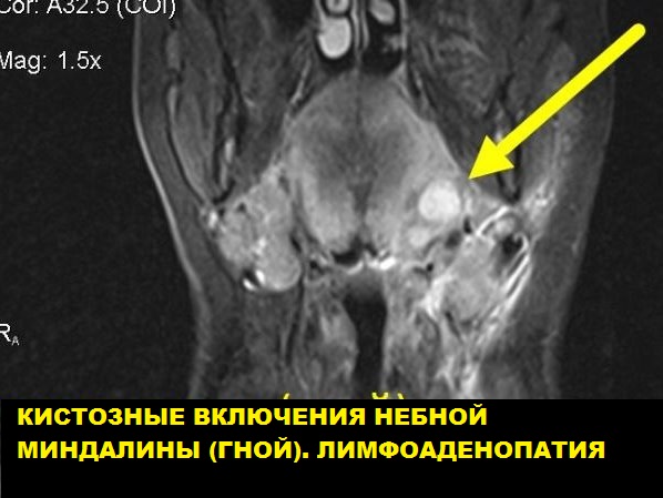 МРТ мягких тканей лицевого черепа