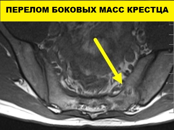 МРТ пояснично-крестцового и крестцово-копчикового отдела позвоночника
