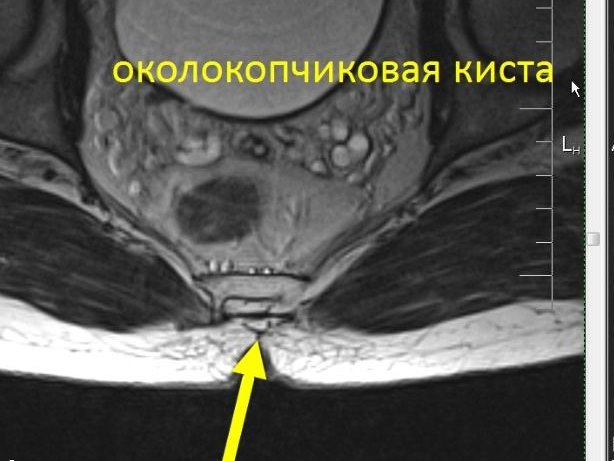 МРТ пояснично-крестцового и крестцово-копчикового отдела позвоночника