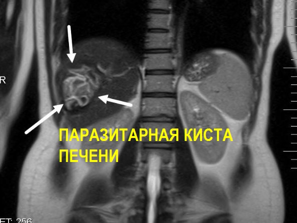 МРТ печени и желчного пузыря