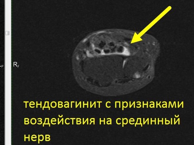 МРТ лучезапястного сустава (один сустав)