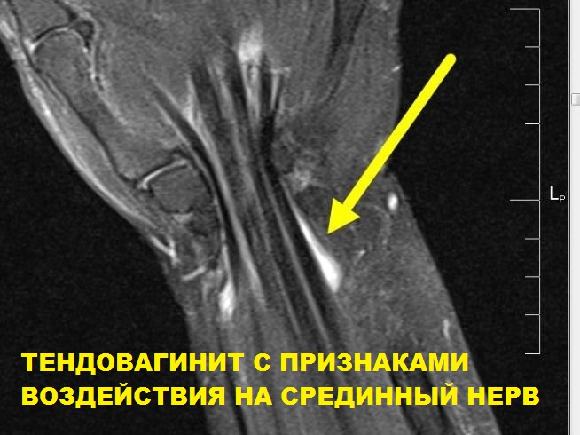 МРТ лучезапястного сустава (один сустав)