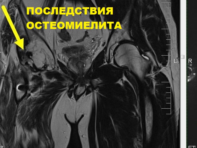 МРТ тазобедренных суставов (пара суставов)