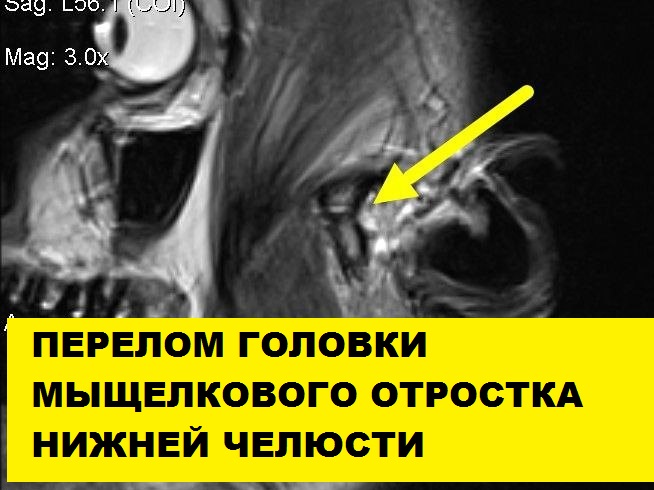 МРТ-исследование височно-нижнечелюстных суставов