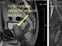 МРТ органов малого таза (простата, мочевой пузырь, семенные пузырьки)
