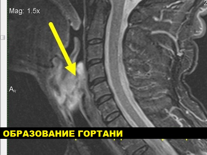 МРТ гортани 