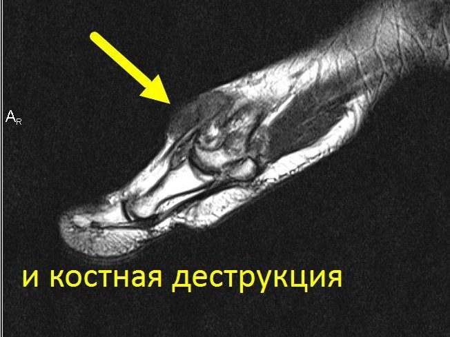 МРТ стопы