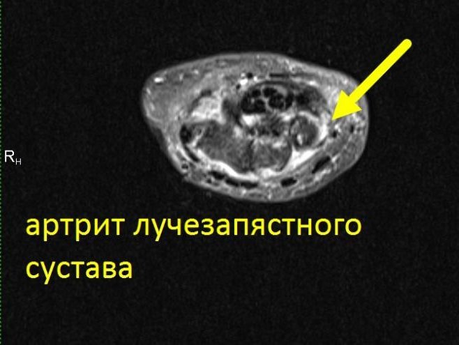 МРТ лучезапястного сустава (один сустав)