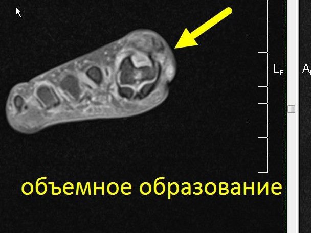 МРТ стопы