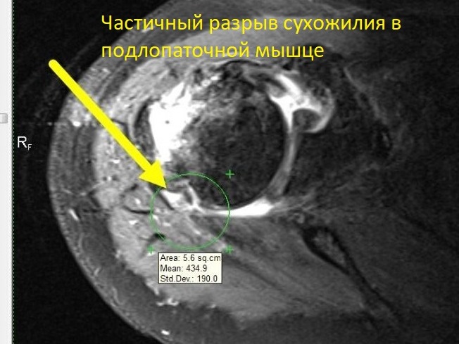 МРТ плечевого сустава