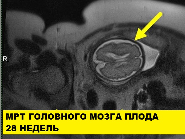 МРТ беременности с 22 недели (пороки развития плода, патология матери, определение пола)