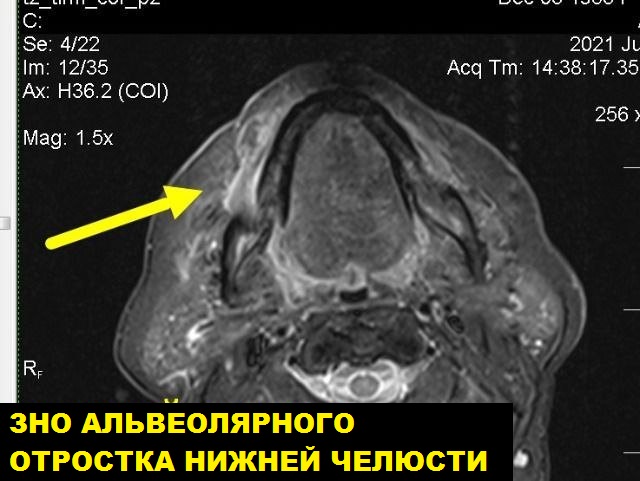 МРТ мягких тканей лицевого черепа
