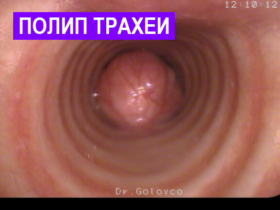 Видео бронхоскопия