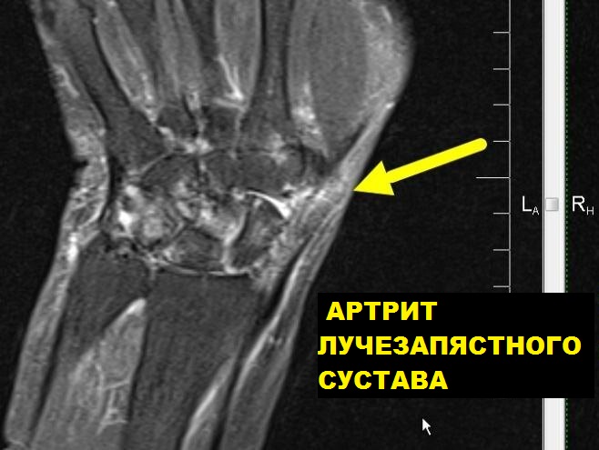 МРТ лучезапястного сустава (один сустав)