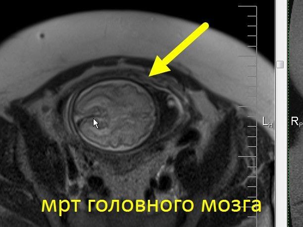 МРТ беременности с 22 недели (пороки развития плода, патология матери, определение пола)