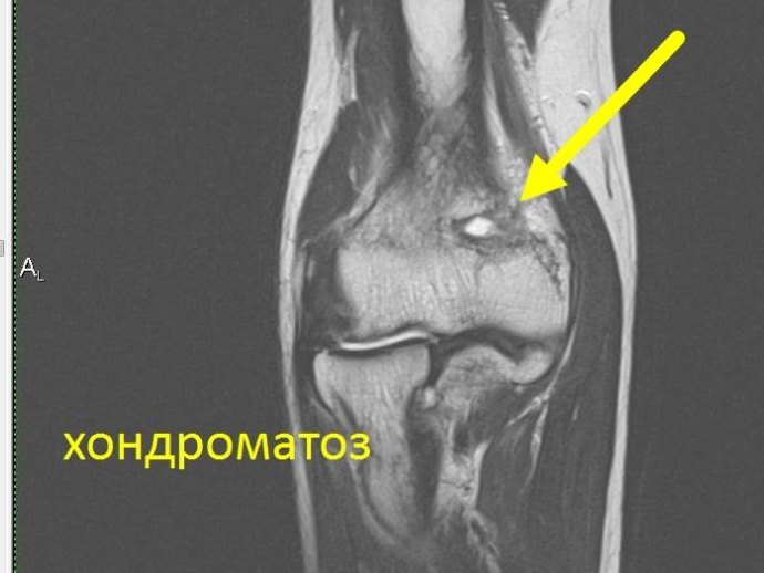 МРТ коленного сустава на 15-канальной катушке