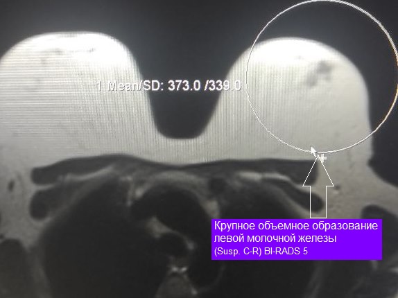 МРТ-исследование молочных желез + контрастирование