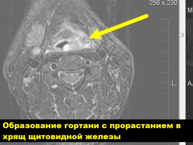 МРТ гортани 