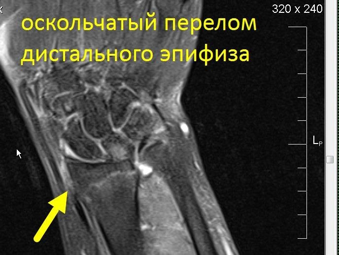 МРТ лучезапястного сустава (один сустав)
