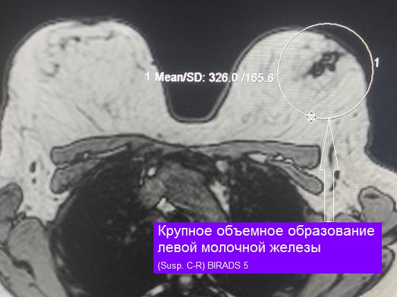 МРТ-исследование молочных желез + контрастирование