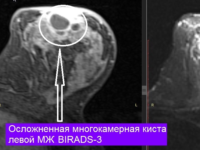 МРТ-исследование молочных желез + контрастирование