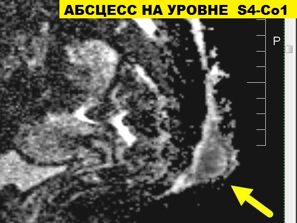 МРТ пояснично-крестцового и крестцово-копчикового отдела позвоночника