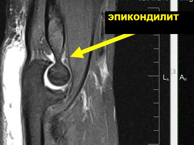 МРТ локтевого сустава
