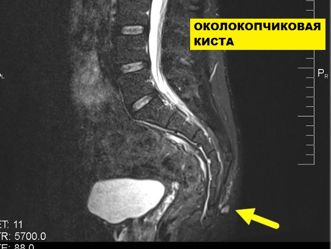 МРТ пояснично-крестцового и крестцово-копчикового отдела позвоночника