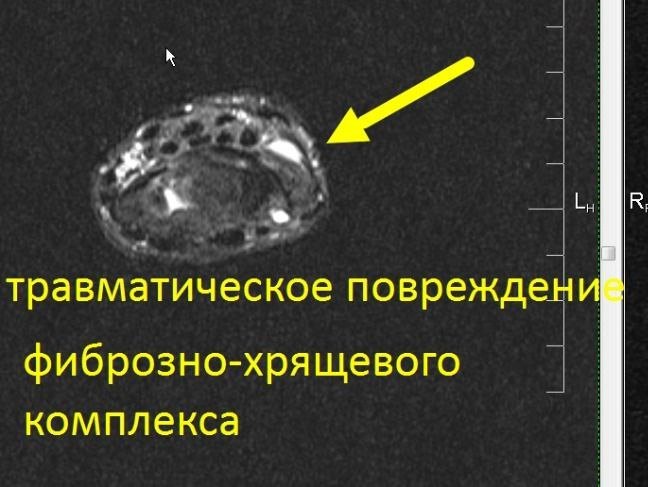 МРТ лучезапястного сустава (один сустав)
