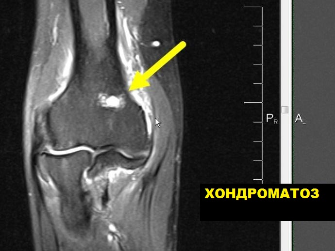 МРТ коленного сустава на 15-канальной катушке
