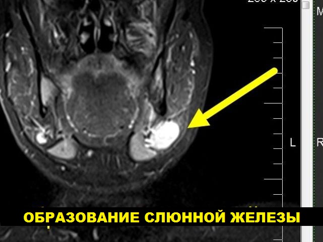 МРТ мягких тканей шеи