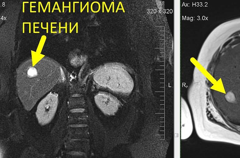 МРТ органов брюшной полости и холангиография (детальный осмотр внутри и вне печеночных желчных протоков)