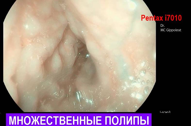 Видеоколоноскопия экспертного класса на аппарате Pentax i7010 (Япония) expert