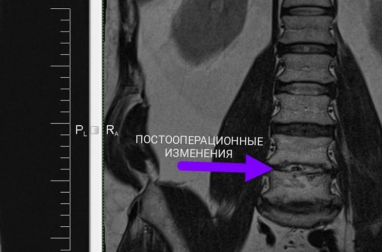 МРТ пояснично-крестцового отдела позвоночника
