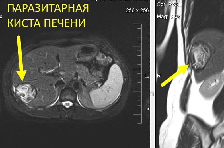 МРТ печени и желчного пузыря