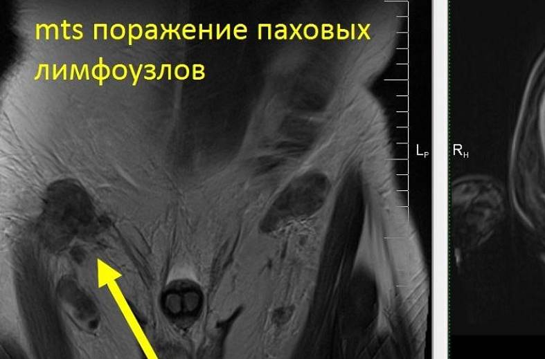 Диффузно-взвешенное магнитно-резонансное изображение (DWI MRI) ( для обеспечивания контрастности картинки)