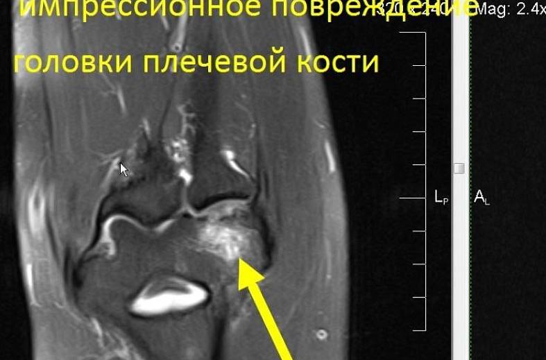 МРТ плечевого сустава