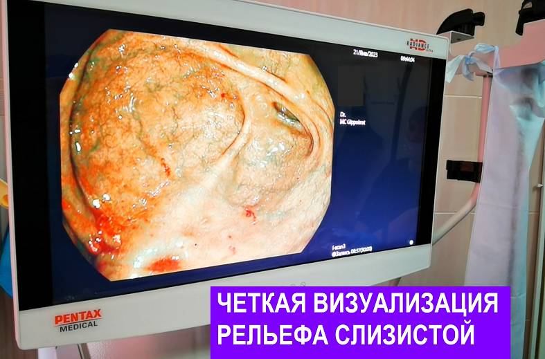 Видеоколоноскопия экспертного класса на аппарате Pentax i7010 (Япония) expert