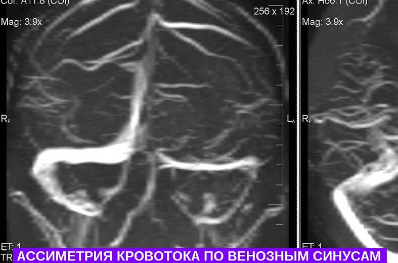Бесконтрастная МРТ венография головного мозга 
