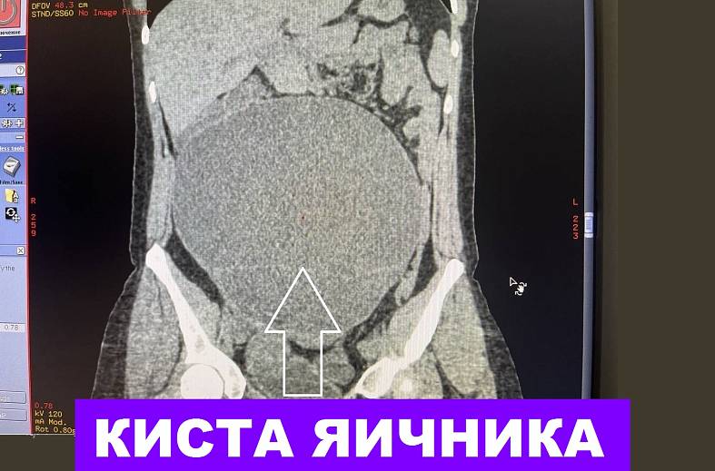 КТ малого таза (женский: матка, яичники, мочевой пузырь)