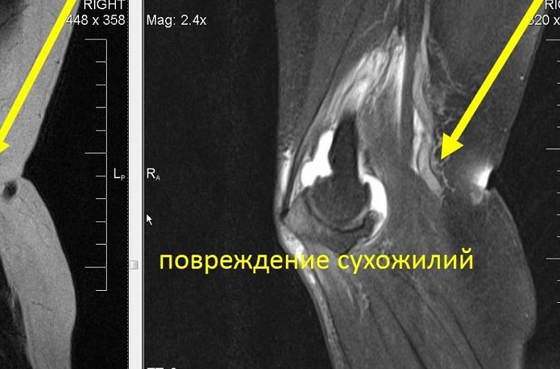 МРТ локтевого сустава