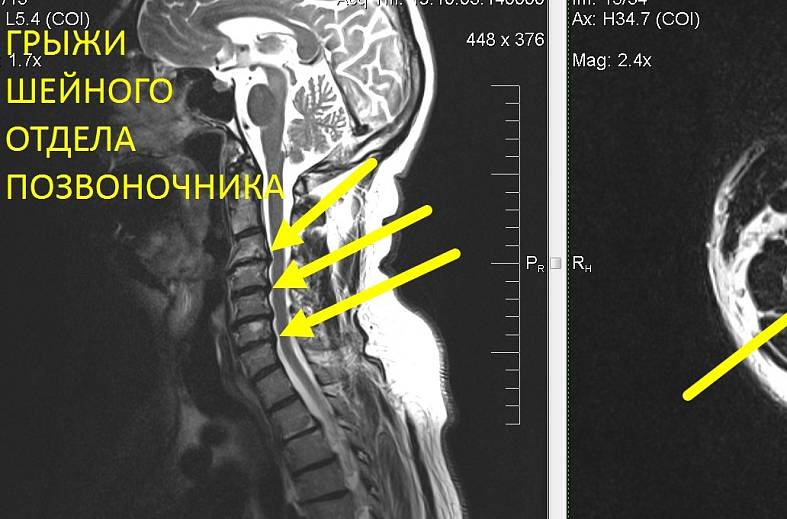 МРТ шейного отдела позвоночника