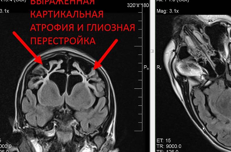 Высокопольная МРТ головного мозга по программе эпилептологического сканирования