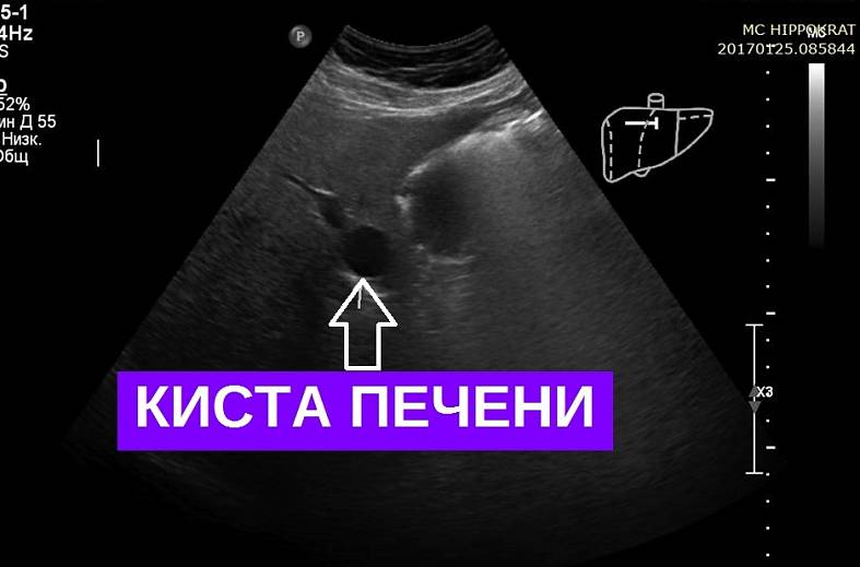 УЗИ печени плюс желчный пузырь