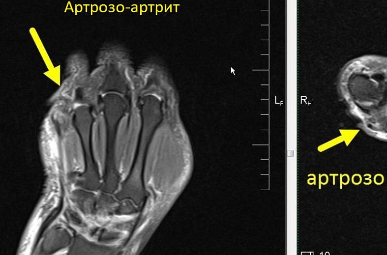 МРТ-исследование кисти