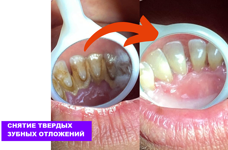 Комплексная чистка одного зуба, ультразвуковая и Air Flow