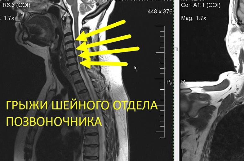 МРТ всего позвоночника (осмотр по ТИМ технологии)