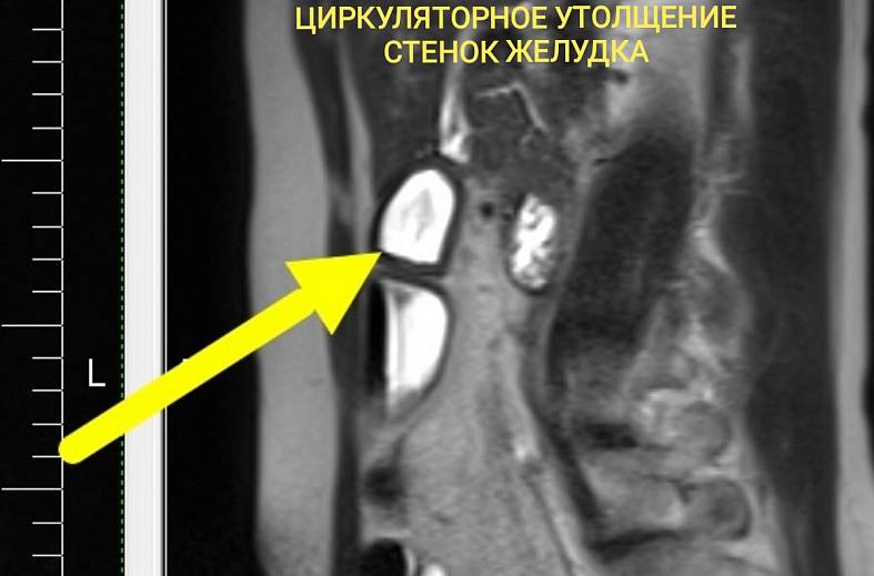 МРТ-желудка с пероральным контрастированием