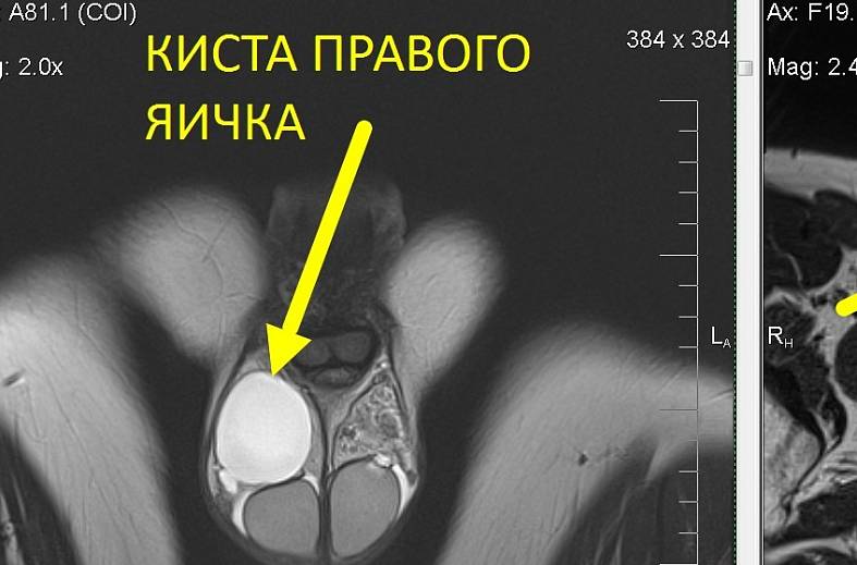 МРТ наружных половых органов (органы мошонки и пенис)