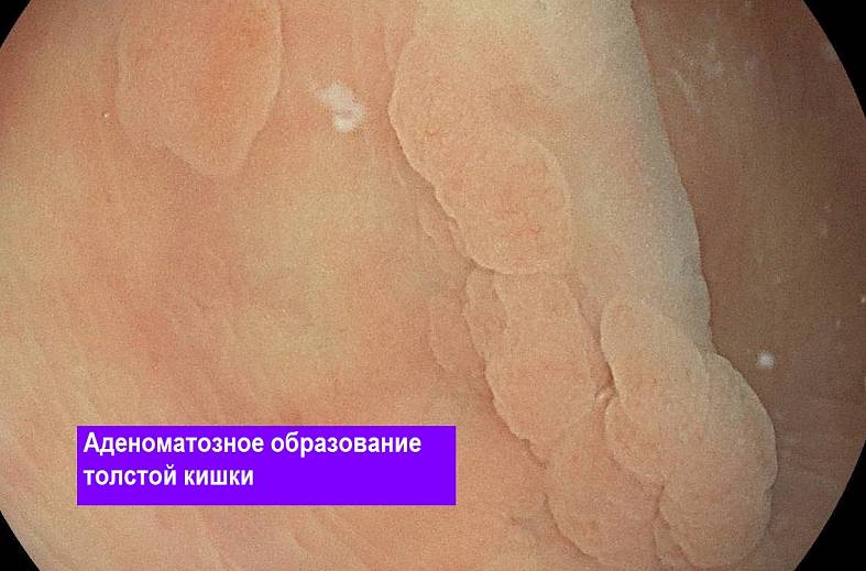 Видеоколоноскопия экспертного класса на аппарате Pentax i7010 (Япония) expert